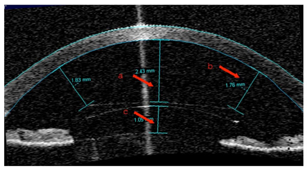 Turbine Rondlopen moordenaar Stability of Cachet Phakic Intraocular Lens Position During 6-Months  Follow-Up